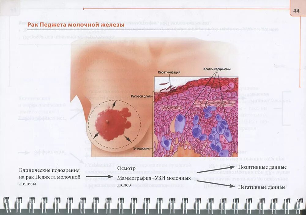 Рак педжета фото начальная стадия молочной железы Книга "Справочник по лечению первичного рака молочной железы" Сайт мед книг