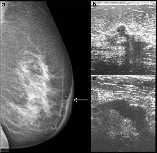 Рак педжета фото начальная стадия симптомы фото Spectrum of Imaging Findings in Paget’s Disease of the Breast—A Pictorial Review