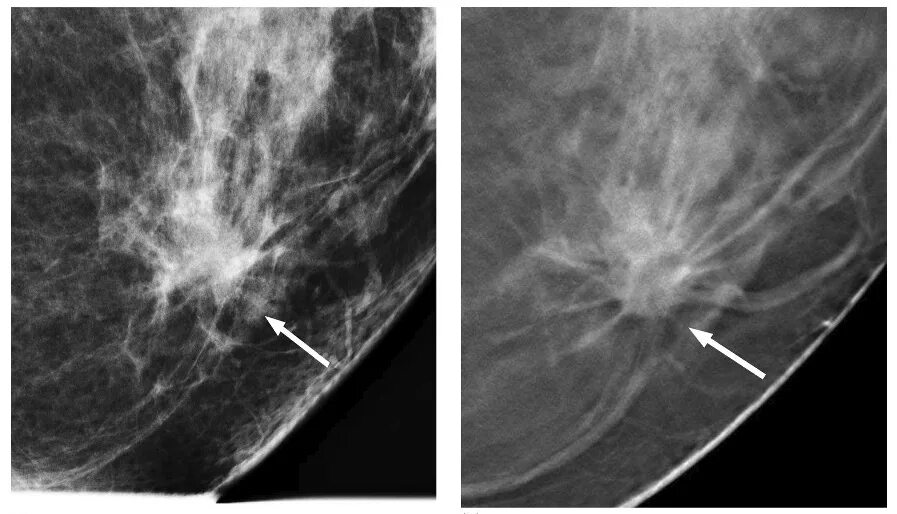 Рак педжета молочной железы фото симптомы Abus Vs Tomosynthesis Online keyshot.cadsoftwaredirect.com