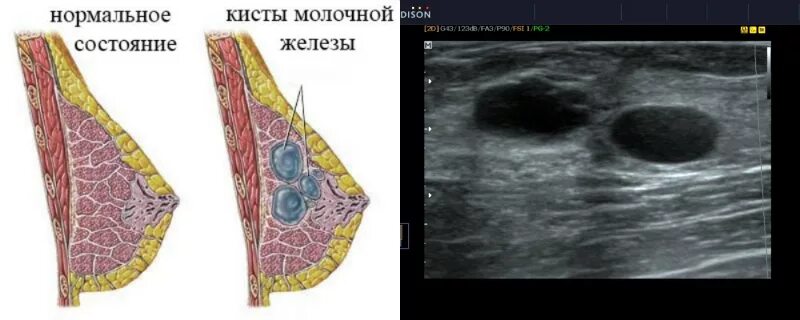 Рак педжета молочной железы фото симптомы Картинки ЕДИНИЧНЫЕ КИСТЫ МОЛОЧНЫХ ЖЕЛЕЗ