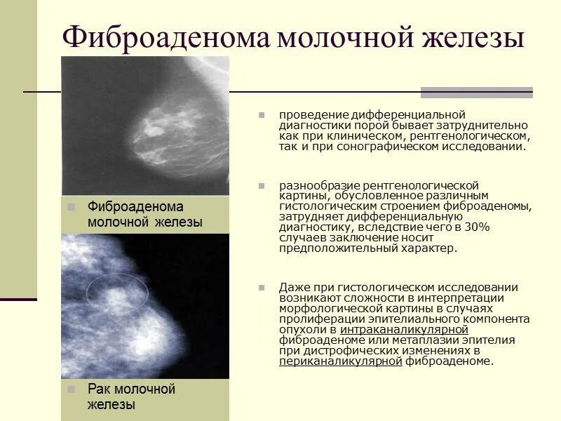 Рак педжета молочной железы фото симптомы Образование молочных желез лечение