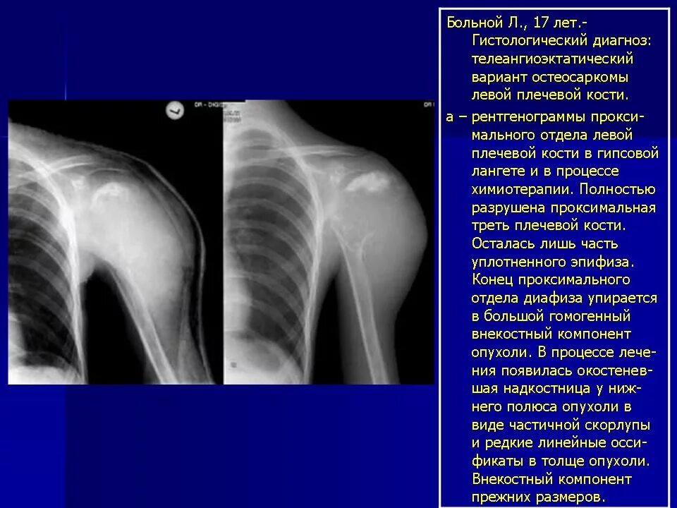 Рак плечевого сустава симптомы фото и лечение Онкология. КСС. Остеогенная саркома. Диагностика остеосарком костей. + Портал ра