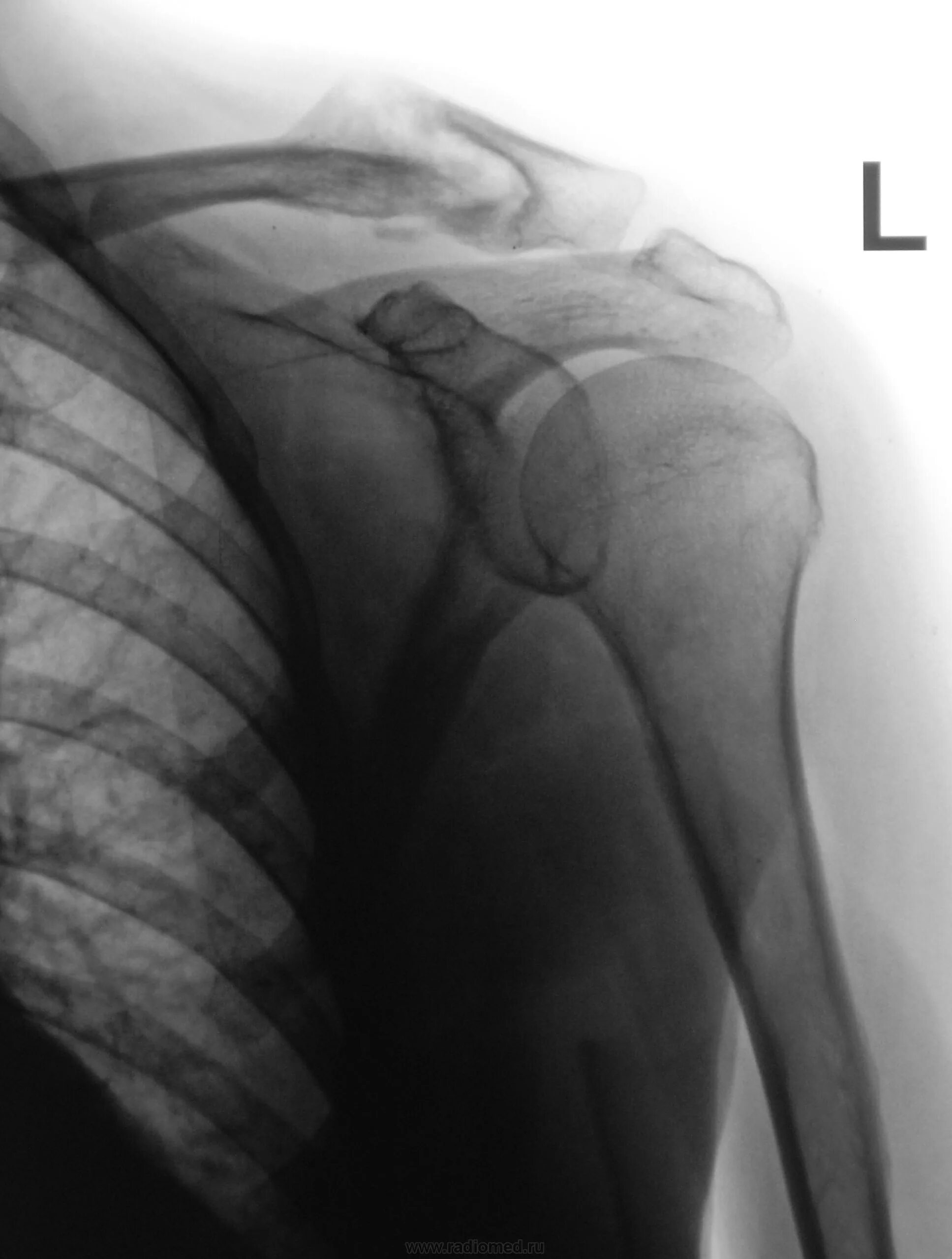 Рак плечевого сустава симптомы фото и лечение Пациент направлен на рентгенографию плечевого сустава хирургом с диагнозом экзос