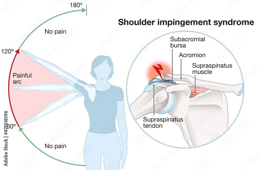 Рак плечевого сустава симптомы фото и лечение Shoulder impingement. Painful arc. Labeled illustration Иллюстрация Stock Adobe 