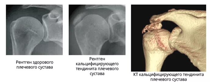 Рак плечевого сустава симптомы фото и лечение Тендинит плечевого сустава: причины, симптомы, виды и лечение