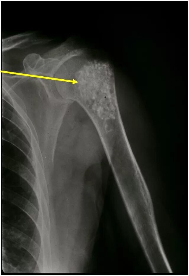 Рак плечевой кости фото Enchondroma : Benign Bone Tumor: Tumors of Bone