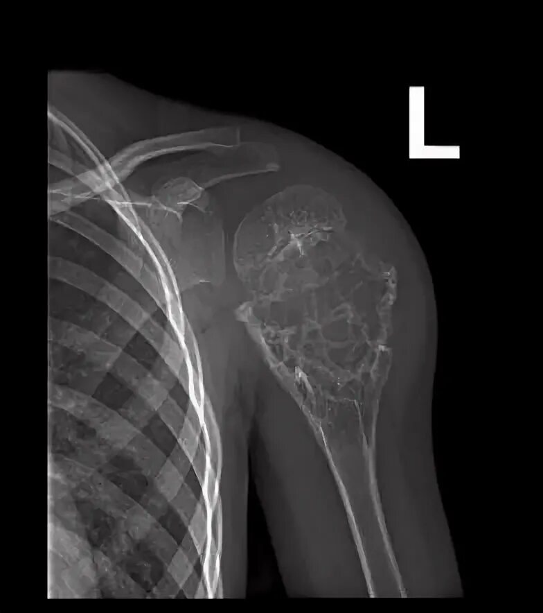 Рак плечевой кости фото Ewing sarcoma Image Radiopaedia.org