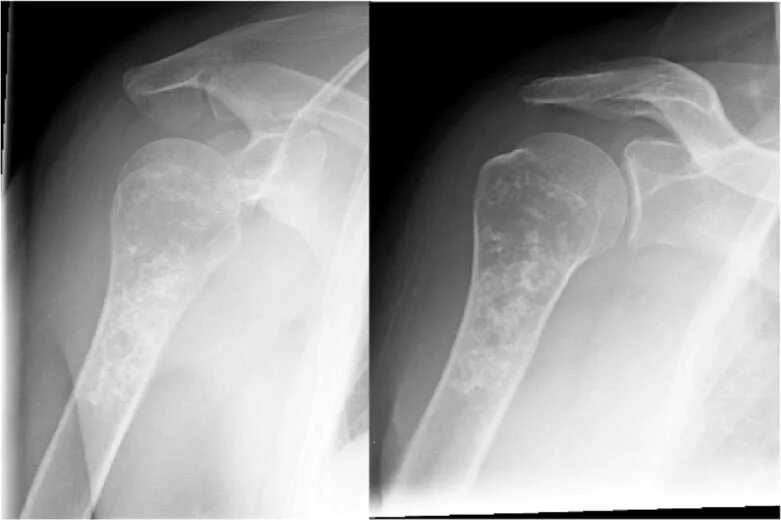 Рак плечевой кости фото Bone Cancer X Ray Images