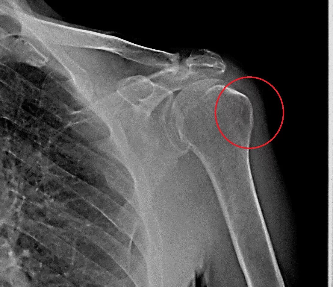 Рак плечевой кости фото Плечелопаточный периартрит - симптомы, лечение, профилактика