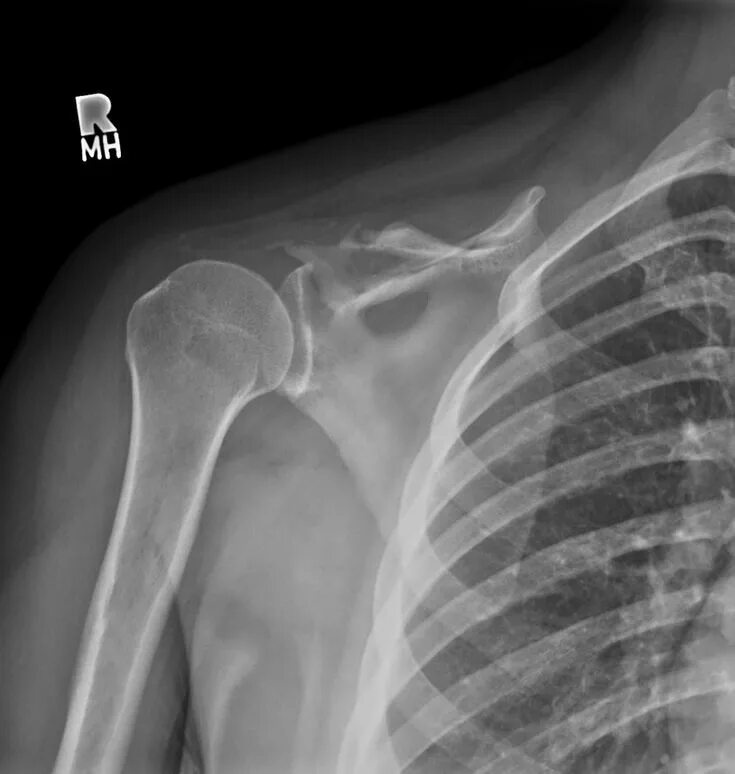 Рак плечевой кости фото GSD - There is absence of the right clavicle, acromion process, and part of the 