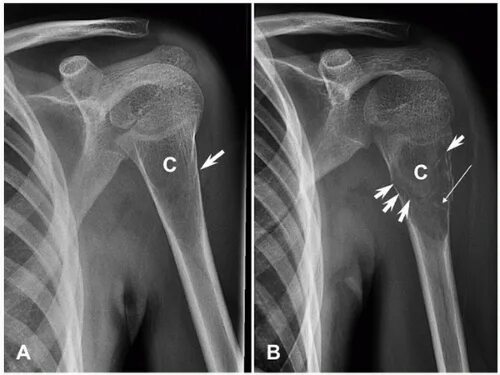 Рак плечевой кости фото Bone Cysts and Giant-Cell Tumor Basicmedical Key