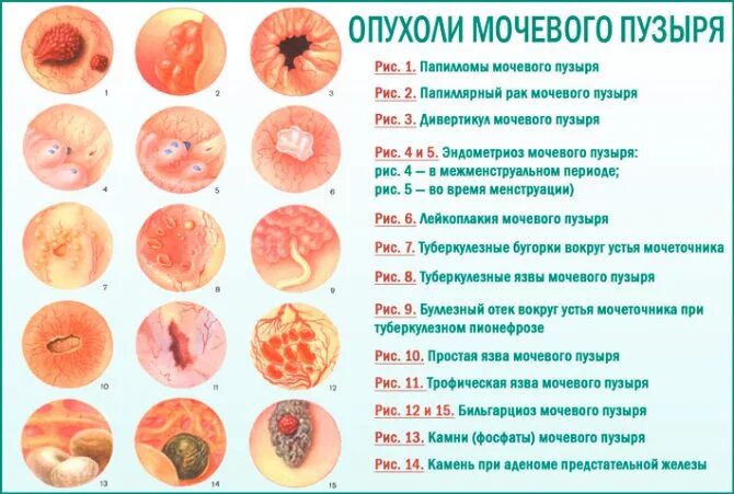 Рак половой губы симптомы фото Симптоми раку сечового міхура у жінок на ранній стадії. Причини, діагностика та 