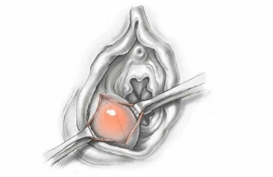 Рак половой губы симптомы и признаки фото Киста бартолиновой железы