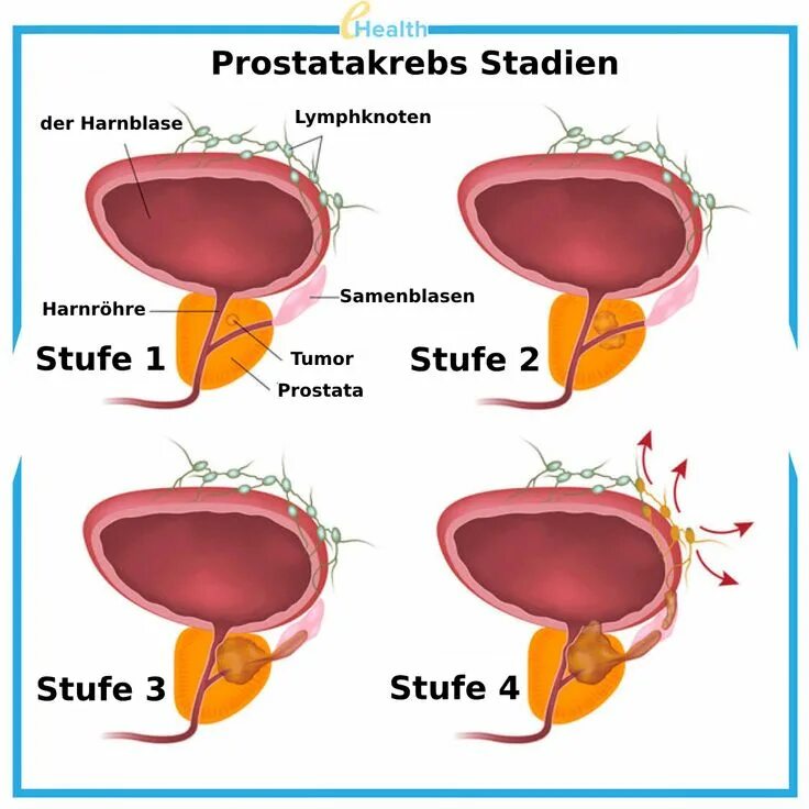 Рак предстательной железы симптомы фото Pin on Gut zu wissen