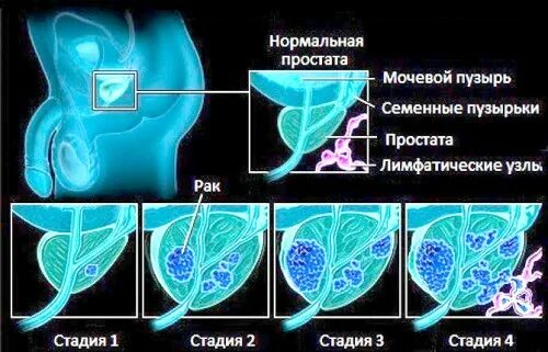 Рак предстательной железы симптомы фото МРТ при раке простаты - показания и результаты диагностики