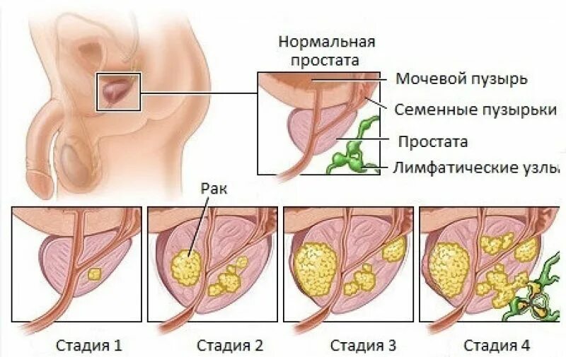 Рак предстательной железы симптомы фото Лечение рака простаты лучевой терапией Радиотерапия при онкологии предстательной