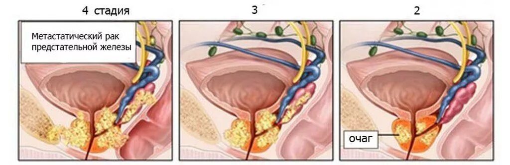 Рак предстательной железы симптомы фото Рак предстательной железы 4 стадии с метастазами