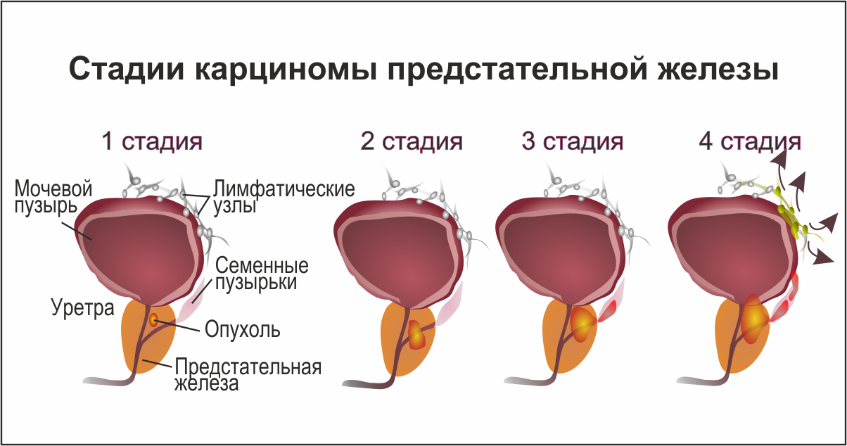 Рак предстательной железы симптомы фото Рак предстательной железы (простаты) - Telegraph