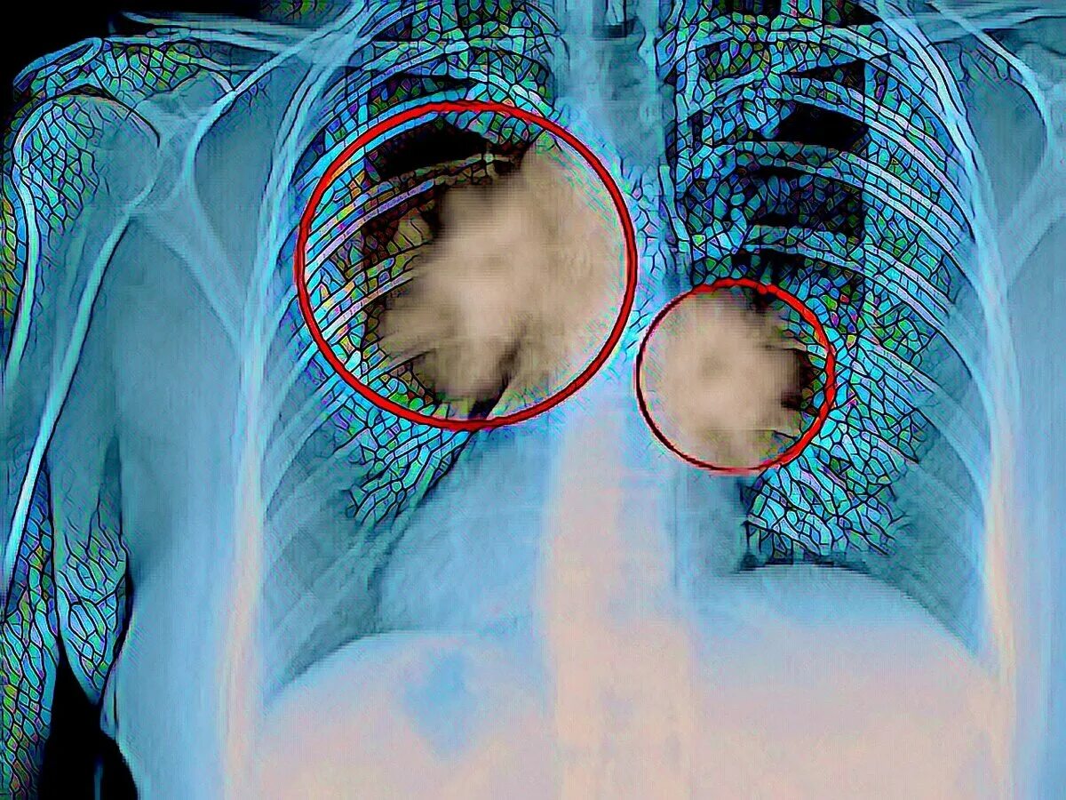 Рак признаки и симптомы фото День рака легких: найдено 83 изображений