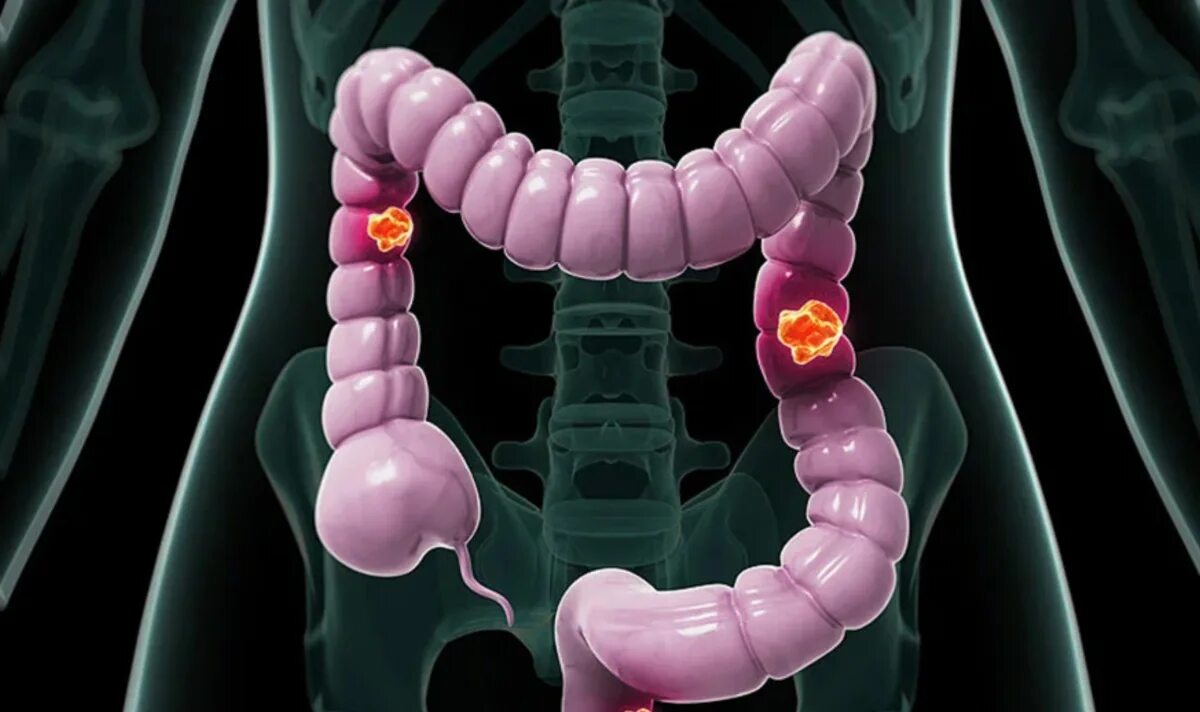Рак прямой кишки фото снаружи как выглядит Врач-онколог Беджанян перечислил первые 6 сигналов опухоли кишечника
