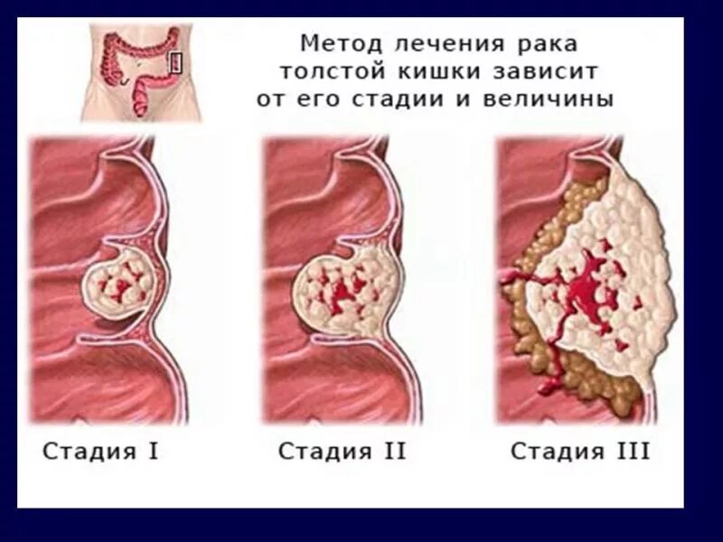 Рак прямой кишки фото снаружи как выглядит Рак толстой кишки