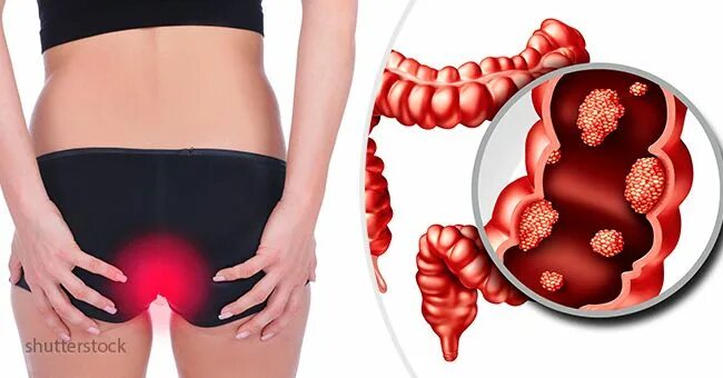 Рак прямой кишки фото снаружи как выглядит Most of these symptoms are usually ignored or mistaken for something minor. This