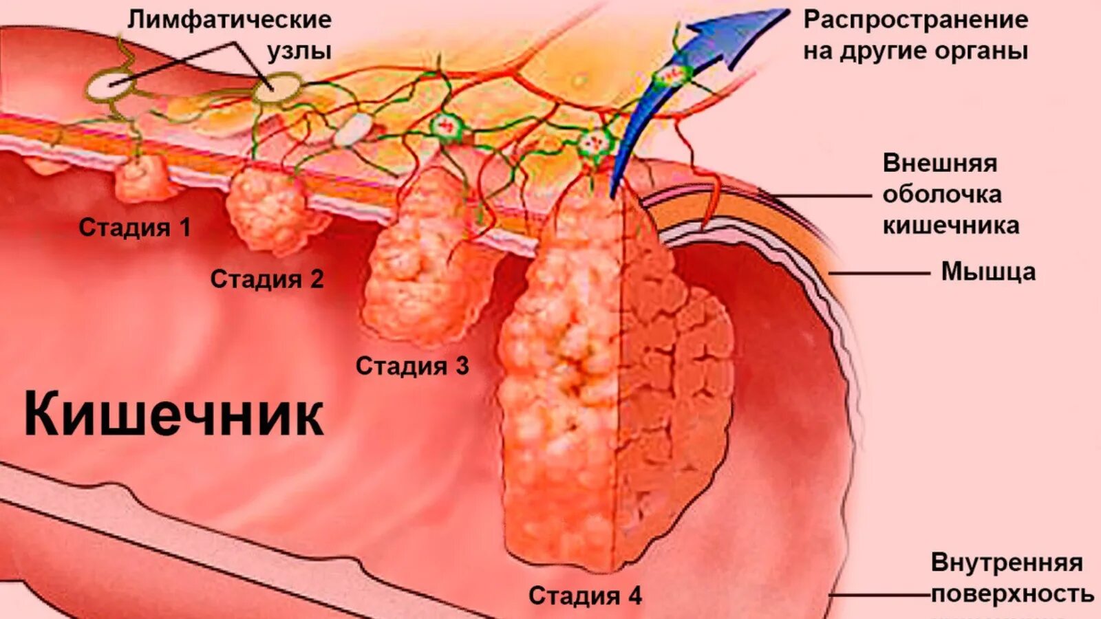 Рак прямой кишки фото снаружи как выглядит ГАУЗ "Мамадышская ЦРБ"