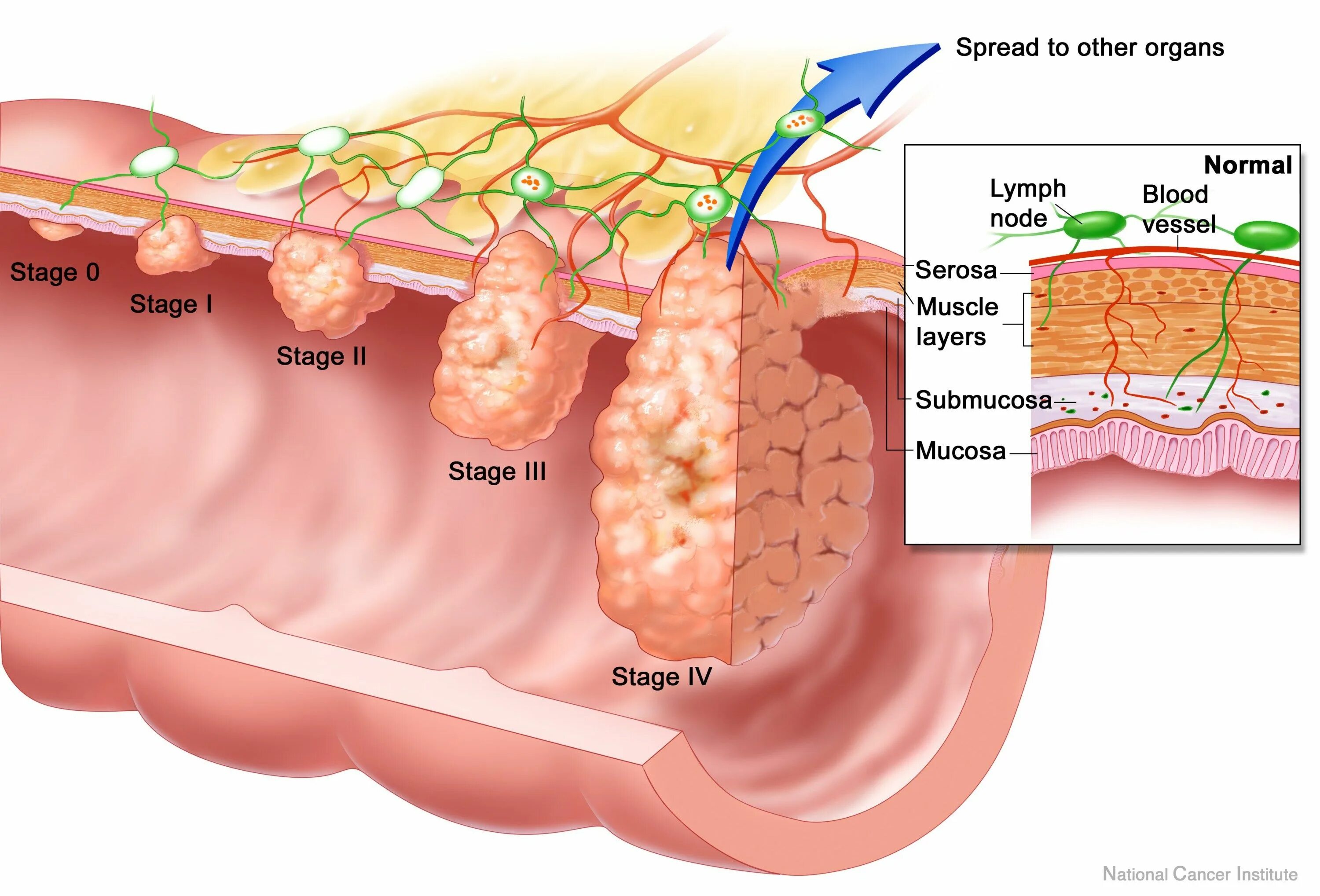 Рак прямой кишки фото снаружи как выглядит Pin em Oncology