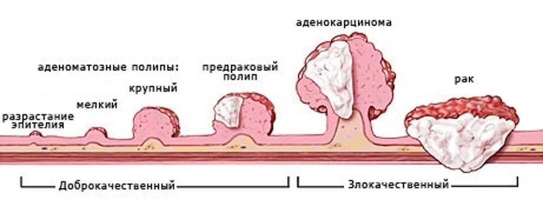 Рак прямой кишки фото снаружи как выглядит Лечение опухоли кишечника в Санкт-Петербурге, стоимость лечения в ПСПбГМУ им. ак