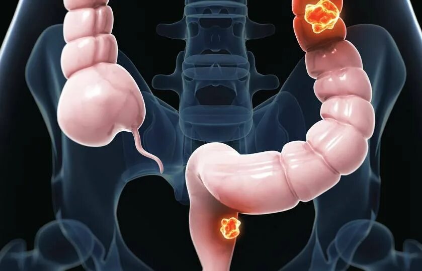 Рак прямой кишки фото снаружи как выглядит Cтадии рака кишечника, прогноз рака кишки с метастазами 4 стадии