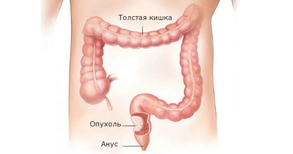 Рак прямой кишки первые симптомы фото Рак толстой кишки, симптомы при карциноме толстой кишки