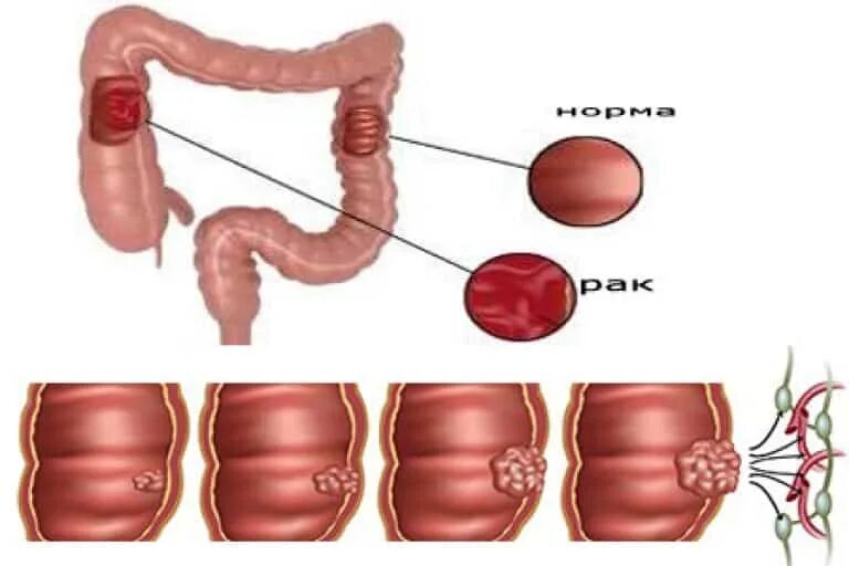 Рак прямой кишки симптомы у женщин фото Рак кишечника 4 стадии с метастазами: прогноз жизни, сколько осталось жить, пита