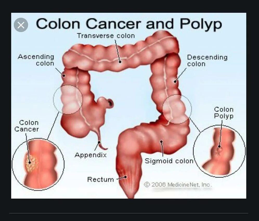 Рак прямой кишки симптомы у женщин фото Рак кишечника признаки и симптомы