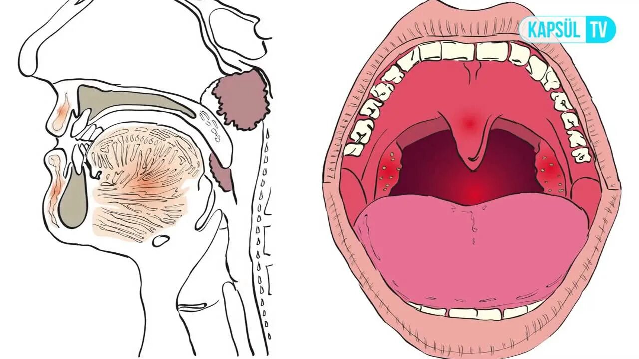 Рак ротоглотки симптомы и фото Geniz Eti Nasıl Alınır? - YouTube