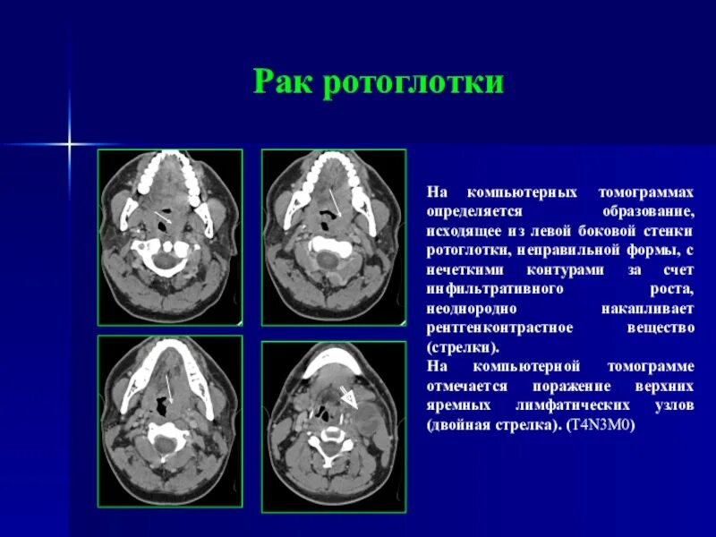 Рак ротоглотки симптомы и фото Лучевая диагностика в онкологии презентация, доклад