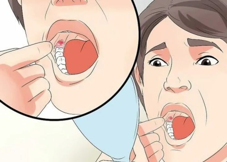 Рак щеки внутри рта фото Reduce Wisdom Teeth Swelling After Removal - Step To Health Wisdom teeth, Wisdom