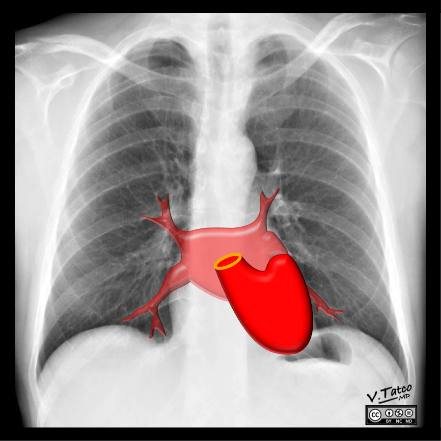 Рак сердца фото Cardiomediastinal anatomy on chest radiography (annotated images) Image Radiopae