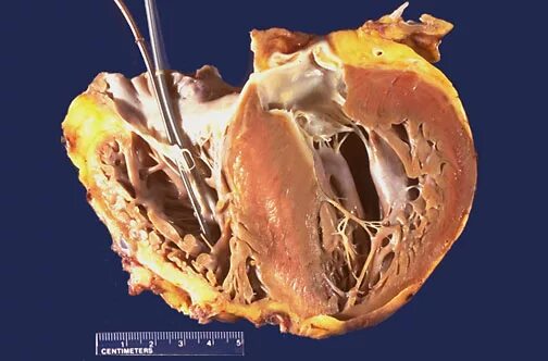 Рак сердца фото Cardiovascular Pathology