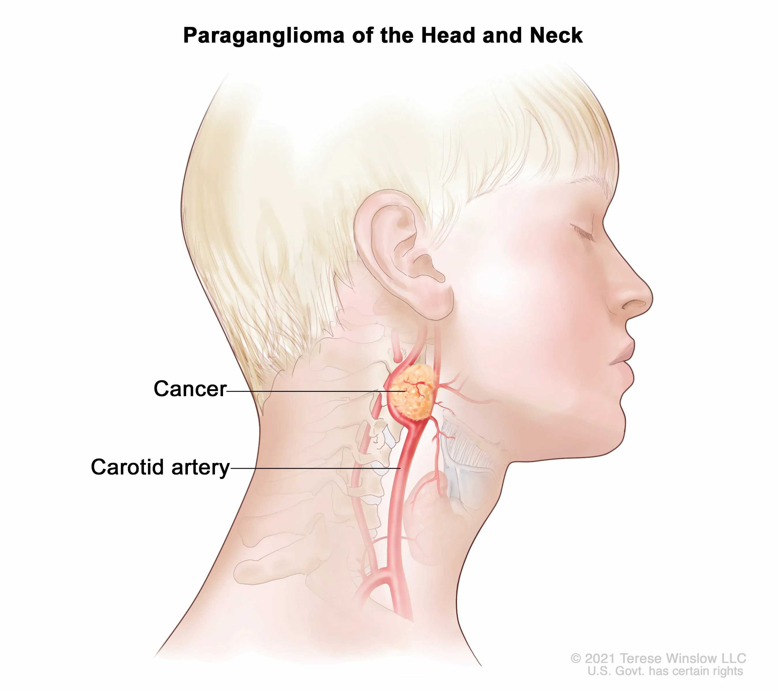 Рак шеи симптомы фото Childhood Pheochromocytoma & Paraganglioma Treatment - NCI