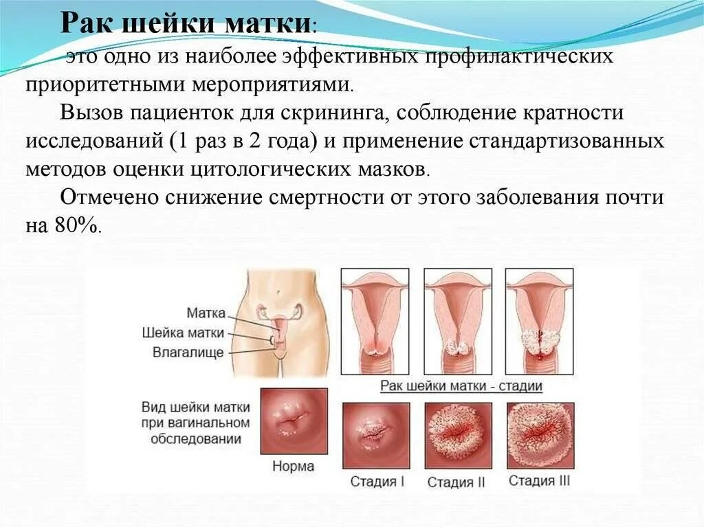 Рак шейки матки симптомы фото Профилактика рака шейки матки.