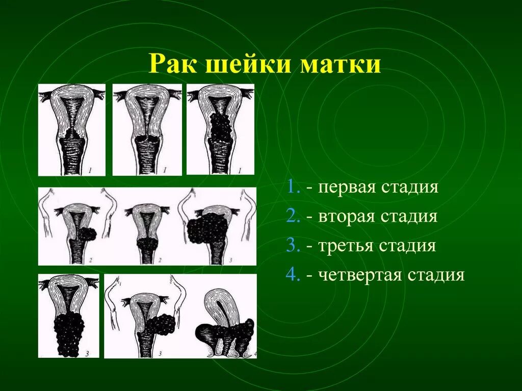 Рак шейки матки стадии фото Ршм 1 стадия