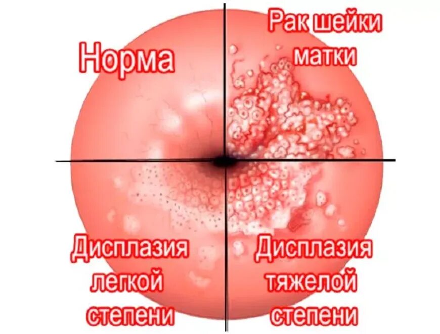Рак шейки матки стадии фото Легкая дисплазия шейки матки - что это и как лечить? - Хирург К. В. Пучков