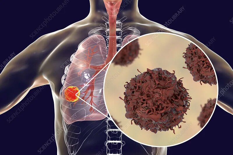 Рак симптомы фото первые признаки рака Lung cancer, illustration - Stock Image - F022/1934 - Science Photo Library