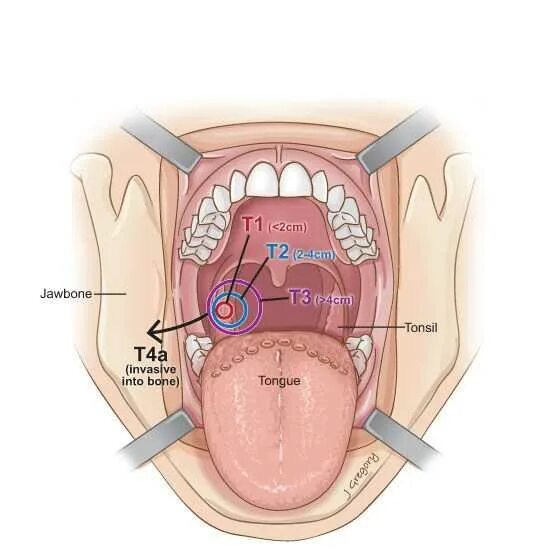 What is Endoscopy * Cancer Basics * THANC Guide