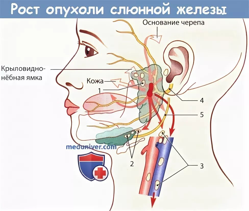 Рак слюнной железы симптомы и фото Симптомы рака слюнной железы и его диагностика