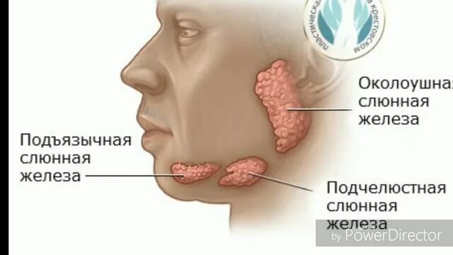 Рак слюнной железы симптомы и фото Подчелюстная слюнная железа. Терапевтическая стоматология. Вопросы на экзаменах.