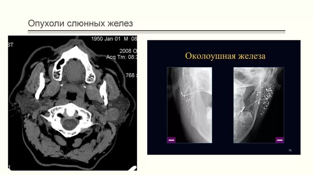 Рак слюнных желез симптомы фото Опухоли слюнной железы классификация: найдено 90 изображений