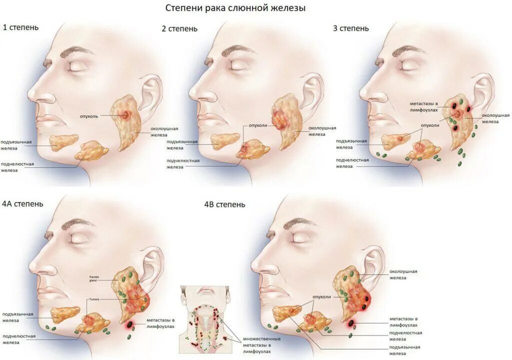 Рак слюнных желез симптомы фото Рак слюнной железы: симптомы, лечение, прогноз жизни eraminerals.ru