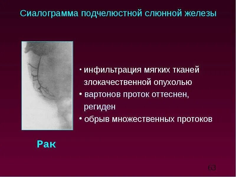 Рак слюнных желез симптомы фото Лучевая диагностика Слюнных Желез - презентация, доклад, проект скачать