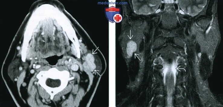 Рак слюнных желез симптомы фото КТ, МРТ при ацинарноклеточном раке околоушной железы